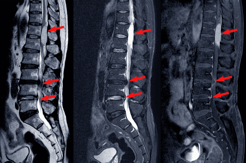 spinal stenosis x-ray