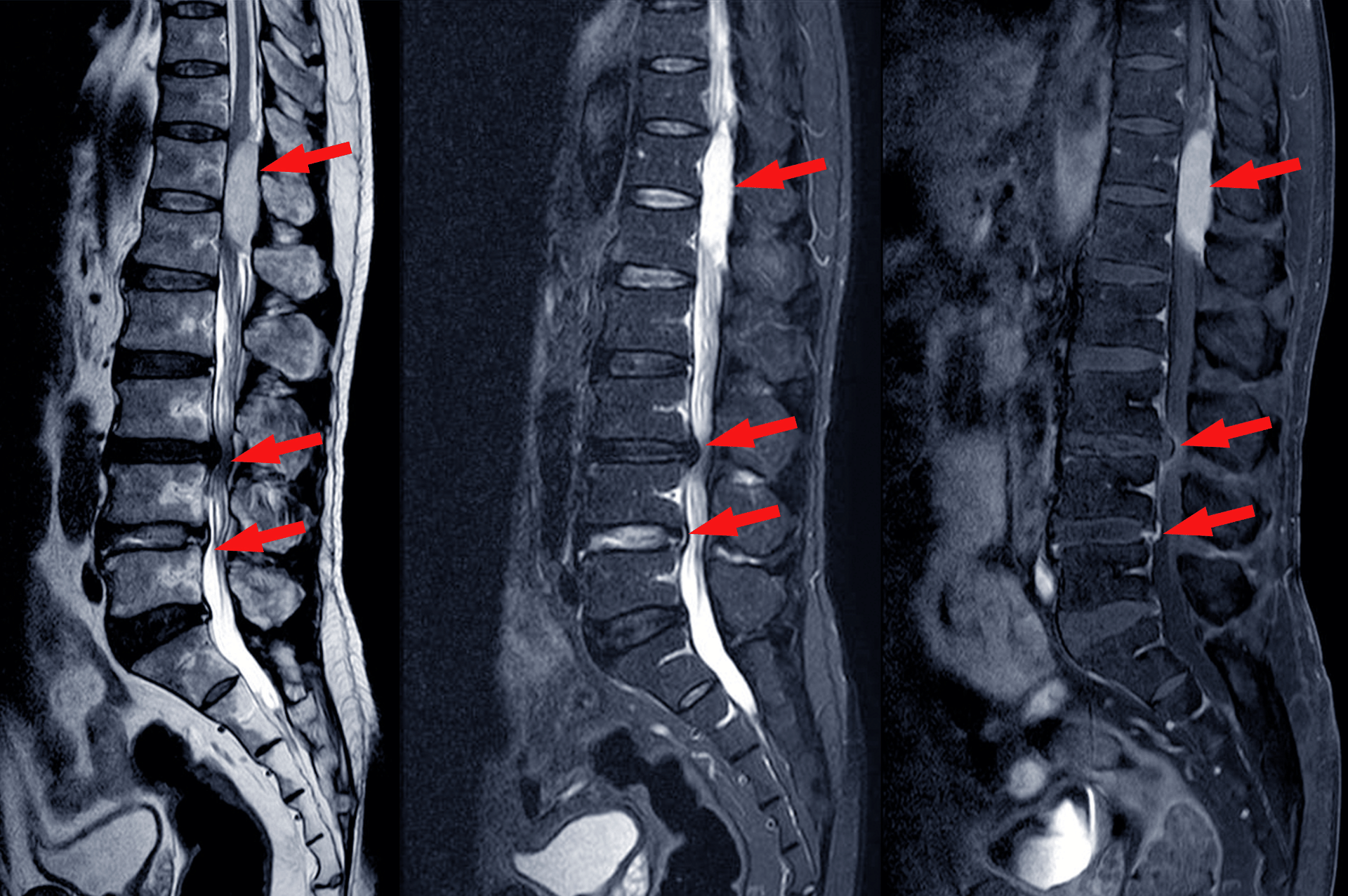 spinal stenosis x-ray