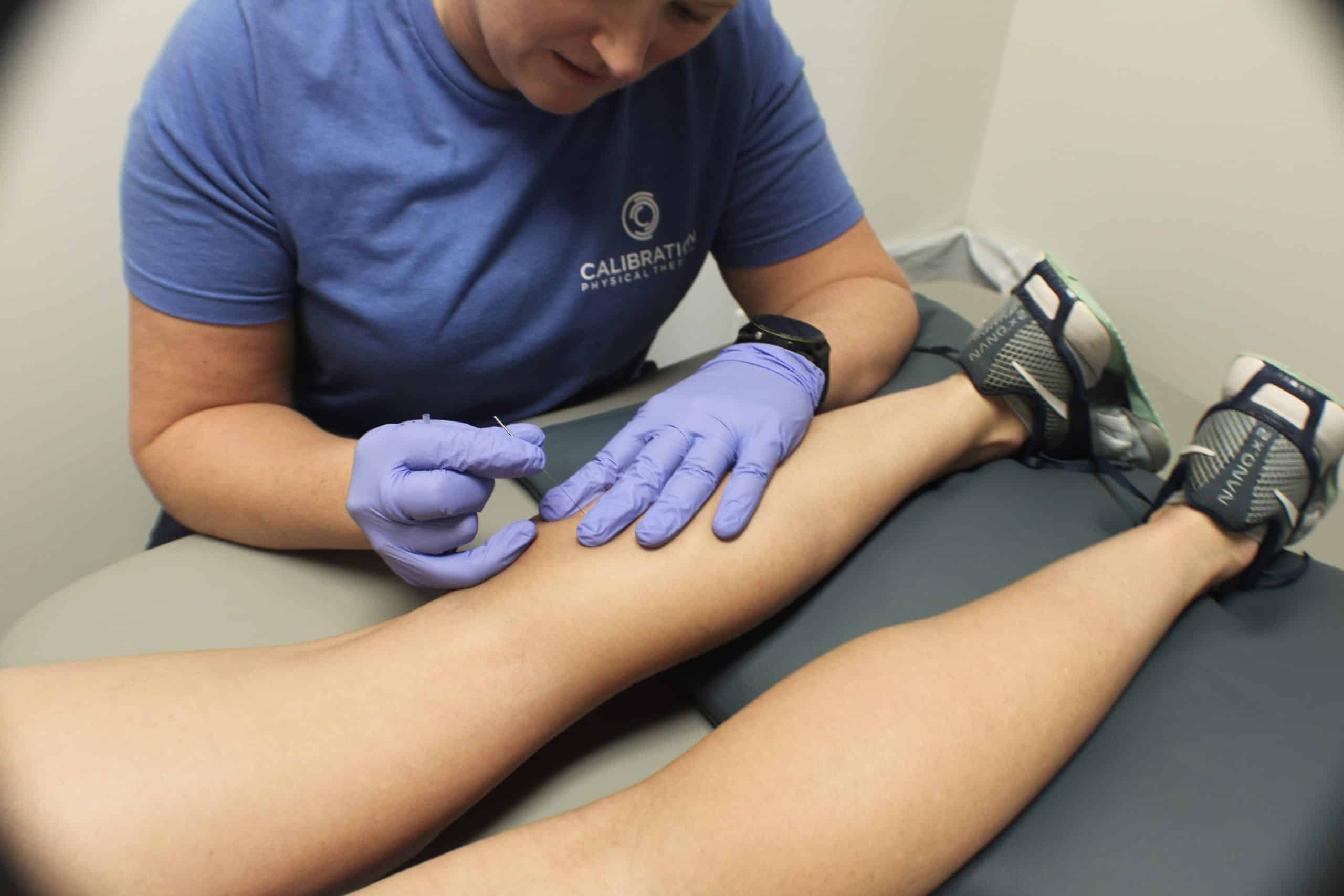 Benefits of Dry Needling in Physical Therapy