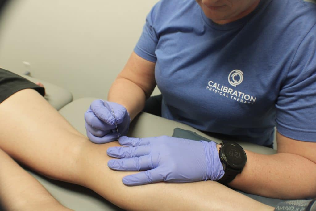 dry needling session