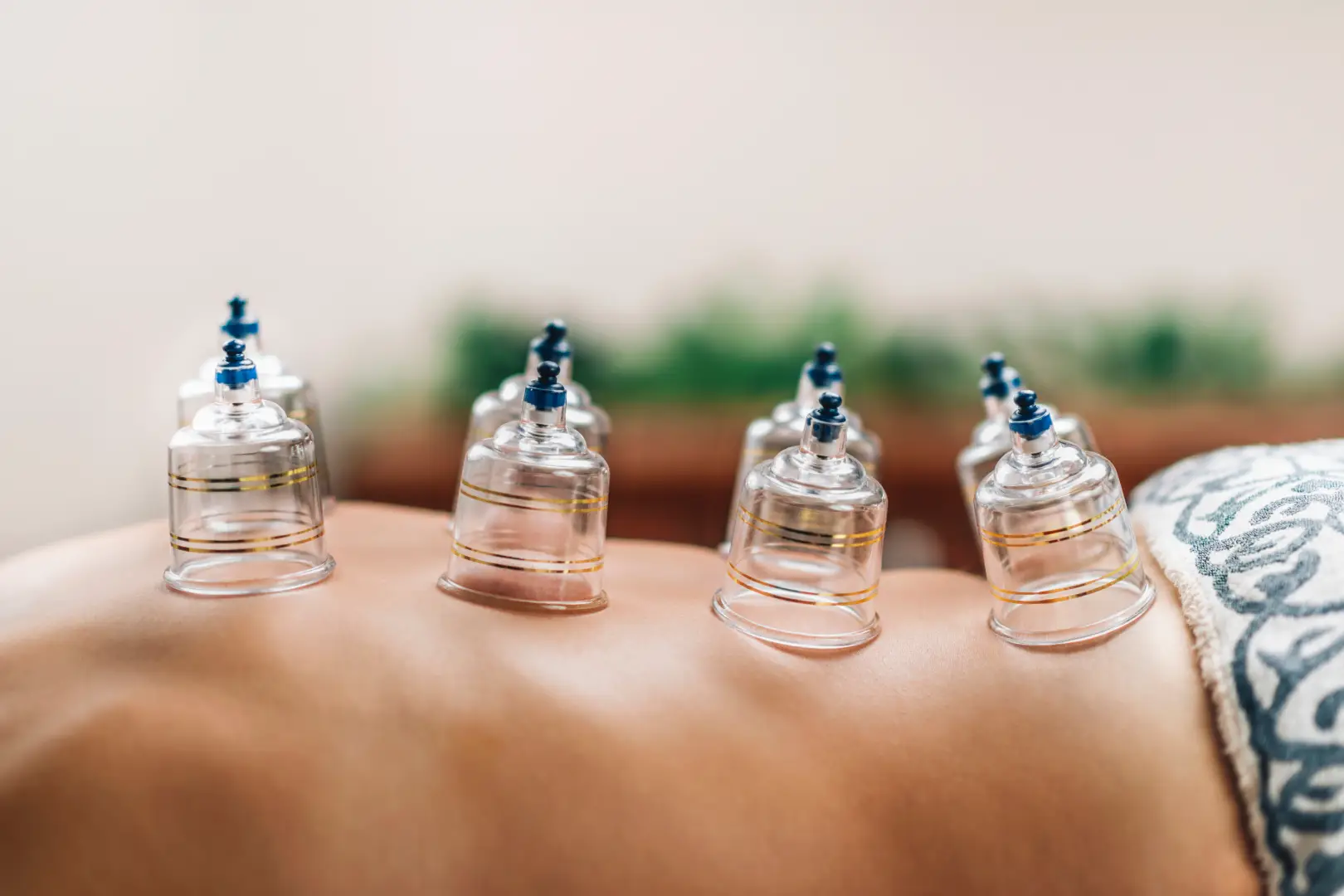 cupping therapy across back