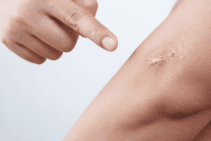 Physical Therapy for Scar Tissue: Understand The Basics