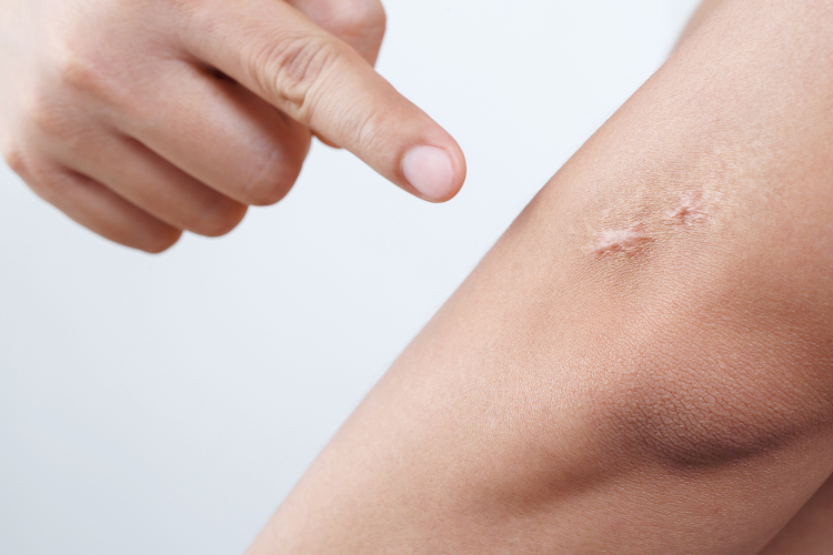 Physical Therapy for Scar Tissue: Understand The Basics