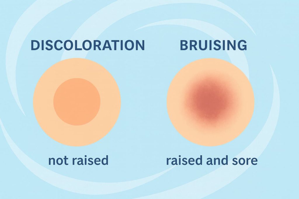 discoloration vs bruising skin with cupping therapy
