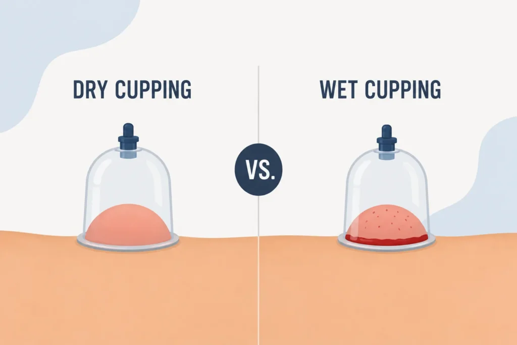 dry cupping vs wet cupping